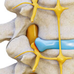 Tratamentos Inovadores para Hérnia de Disco: Soluções Sem Cirurgia