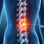 causas da dor no nervo ciático