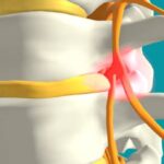 Dores no Nervo Ciático? Saiba Como Aliviar e Recuperar Sua Mobilidade