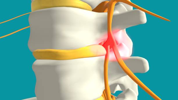 Dores no Nervo Ciático? Saiba Como Aliviar e Recuperar Sua Mobilidade